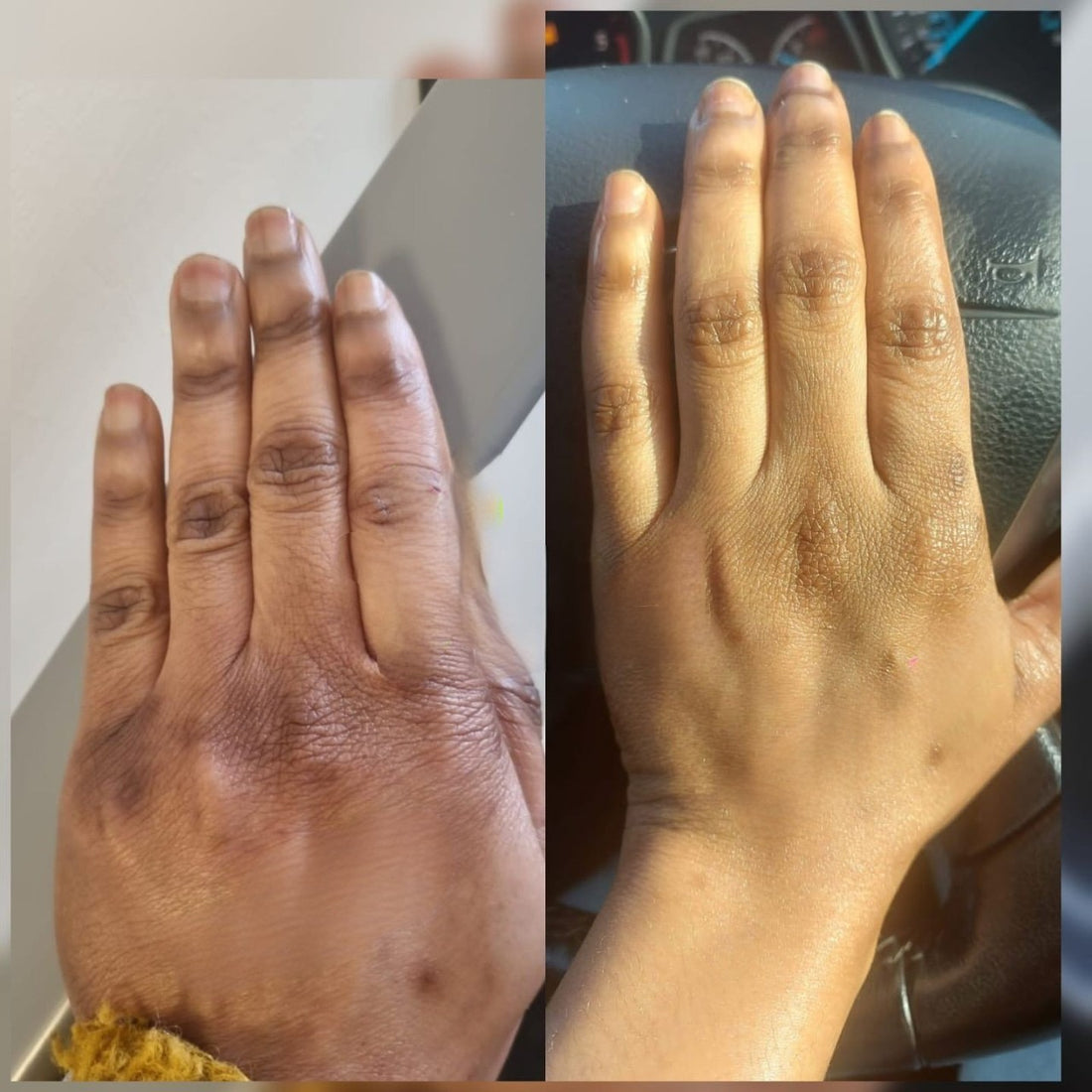 Treating Dark Knuckles with Niacinamide (Vitamin B3): A Proven Solution